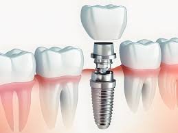 Dental Implant